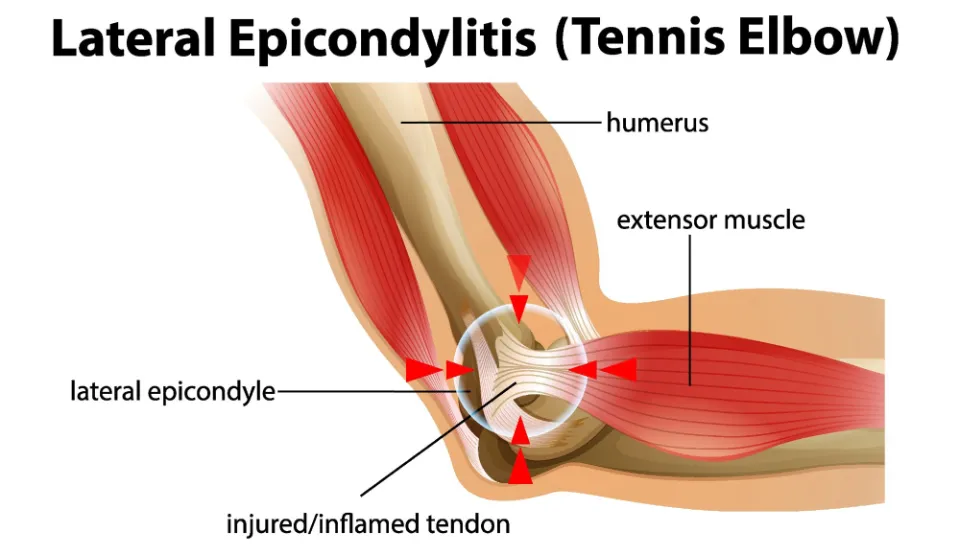 Tennis Elbow from Weight Lifting: How to Treat?